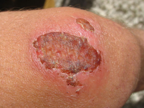Rodilla con una costra.