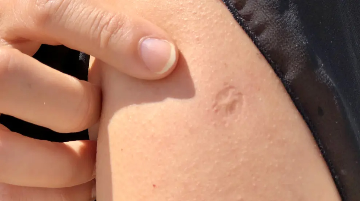 Brazo con la marca de la vacuna.